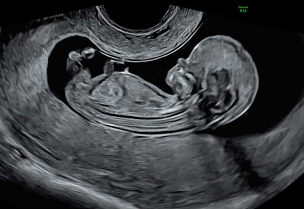 Siêu âm thai nhi 13 tuần tuổi